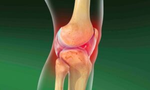 Calcification in the Kneecap