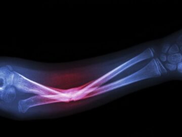 Bone Fracture Symptoms
