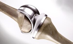 Knee arthroplasty prices