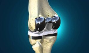 Knee arthroplasty prices