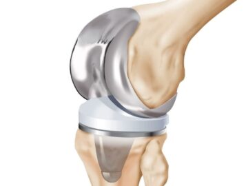 Knee arthroplasty prices