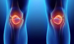 Degrees of Meniscus Tears