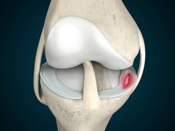 Degrees of Meniscus Tears