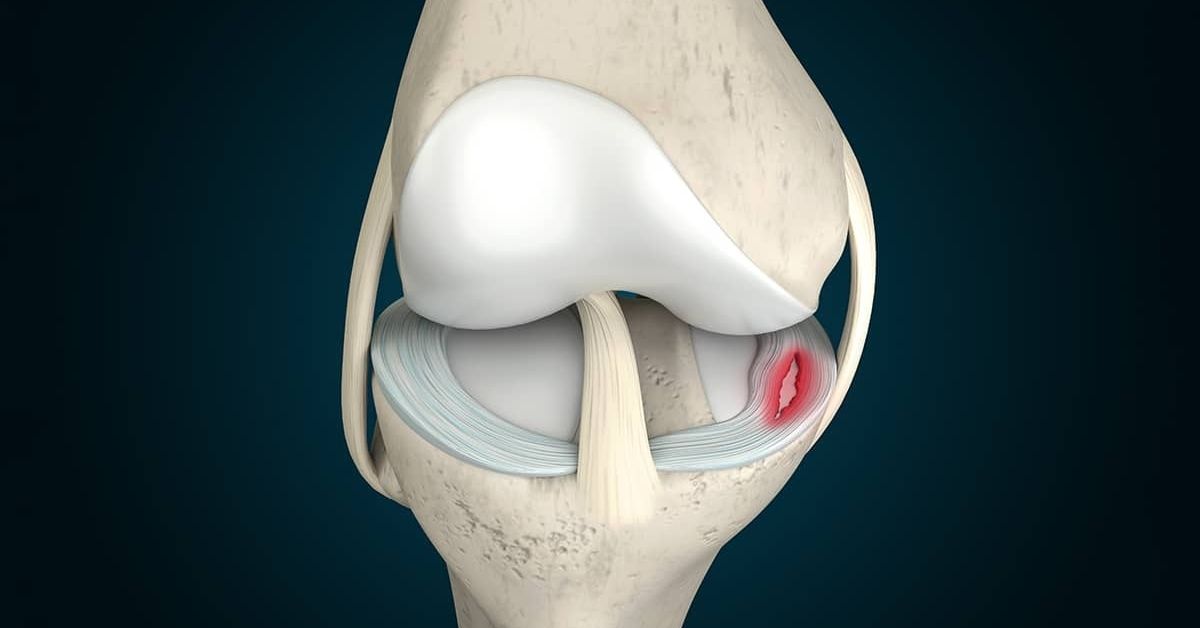 Degrees of Meniscus Tears