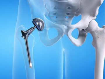Total Hip Replacement