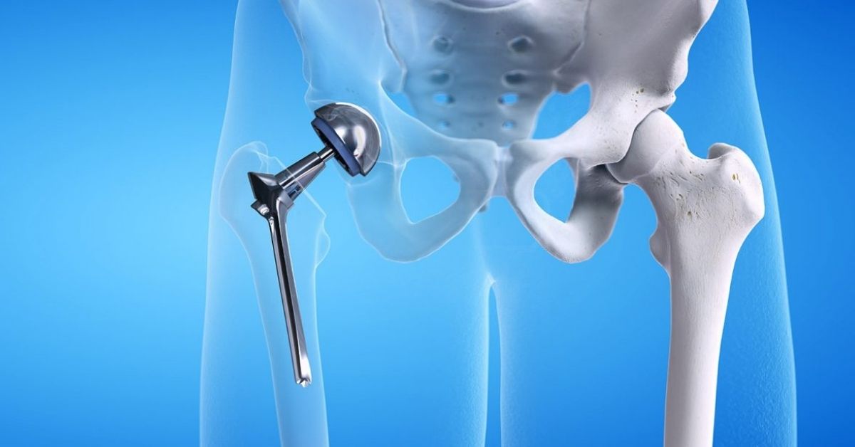 Total Hip Replacement