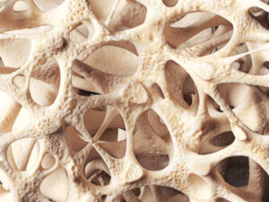 Treatment of Osteoporosis at an Early Age