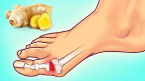 What is Gout?