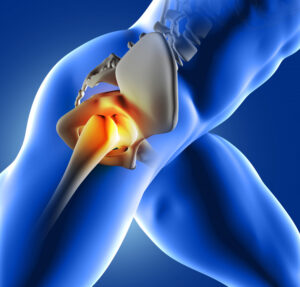 What is Hip Replacement Surgery?