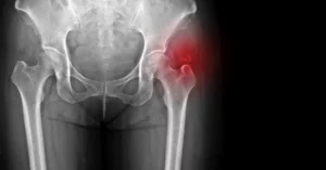 Reasons for Hip Joint Calcification