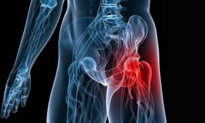 Hip Joint Calcification Treatment