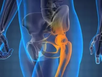 What Causes Hip Joint Calcification?