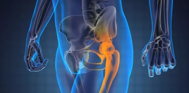 What Causes Hip Joint Calcification?