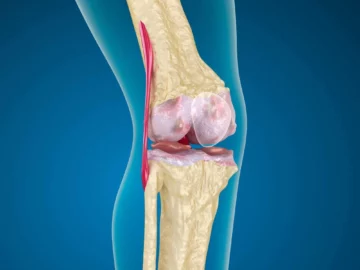 Knee Calcification Treatment