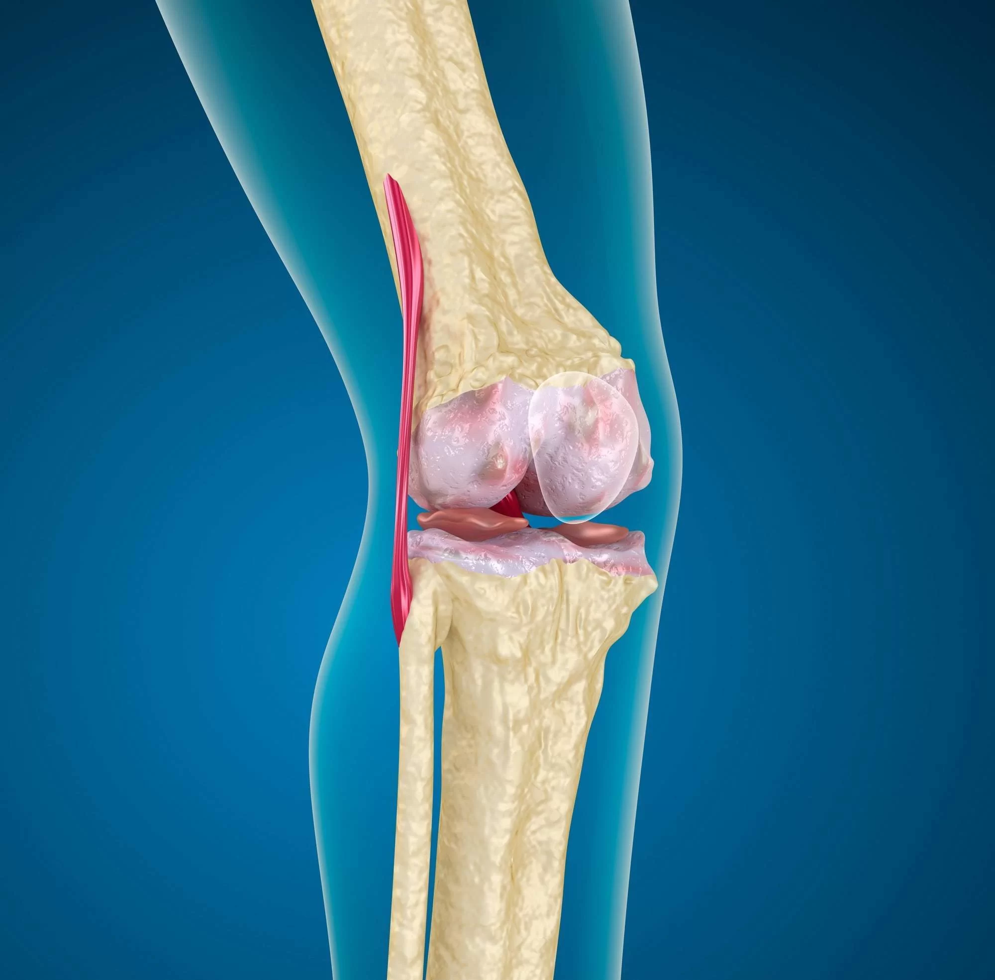 Лечение кальцификации коленного сустава