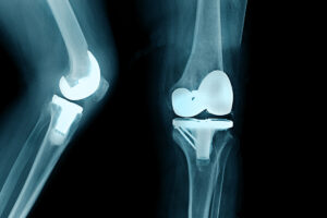 Что такое тотальный протез коленного сустава?