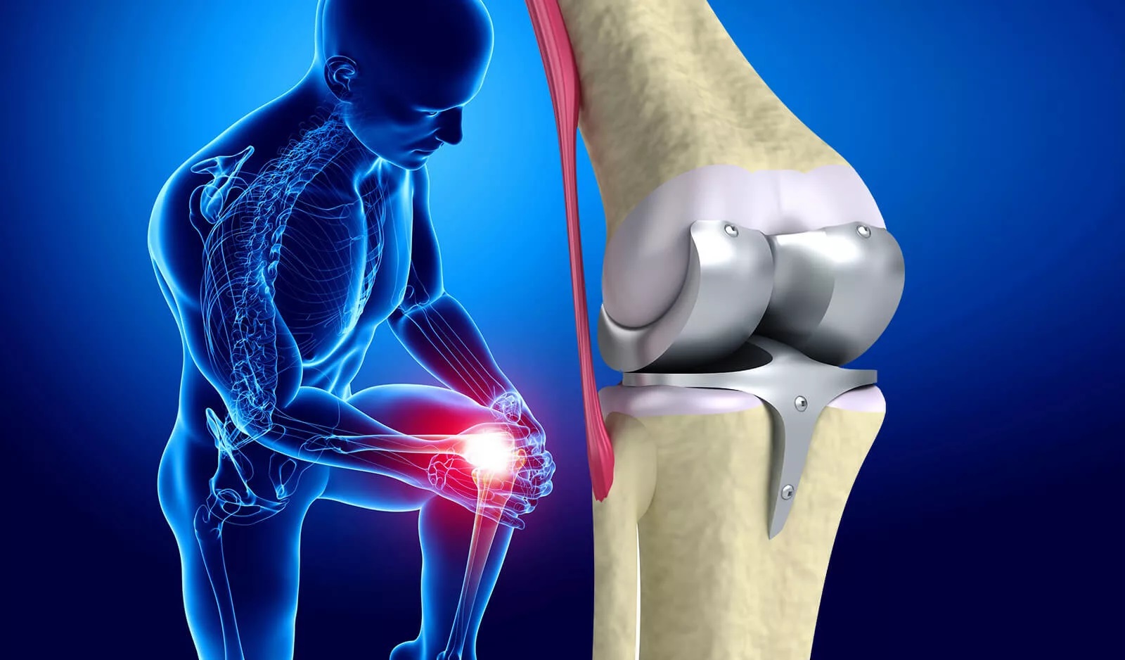 Что такое одномыщелковый протез коленного сустава?