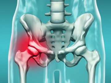 Hip Joint Fracture