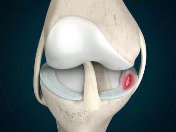 How Long Does Meniscus Tear Surgery Take?