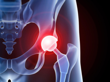 Hip Dislocation in the Elderly