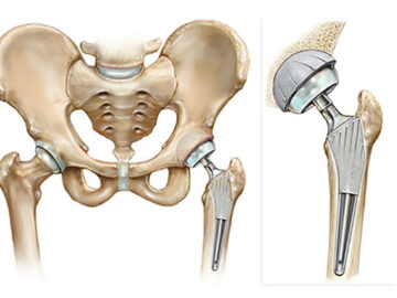 Hip Replacement Surgery in the Elderly