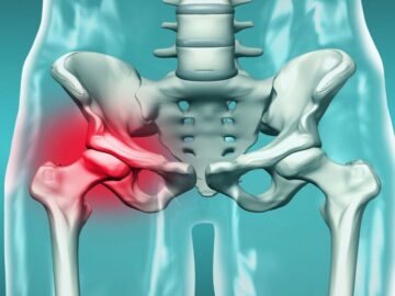 Gençlerde Kalça Çıkığı