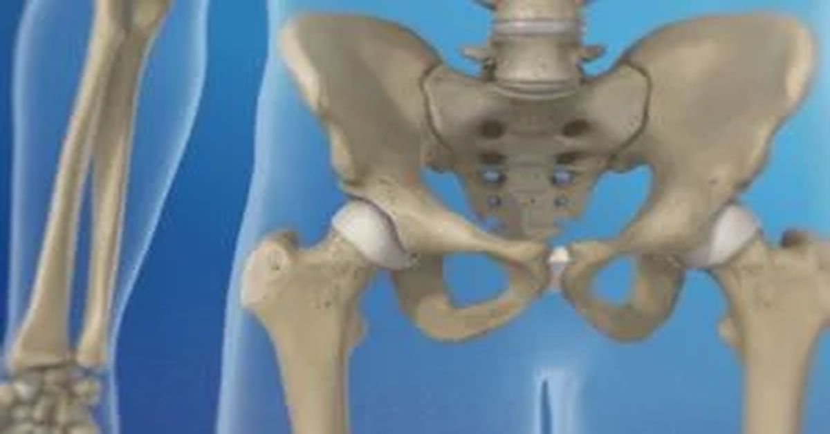 Kalça Kireçlenmesi Neden Olur?