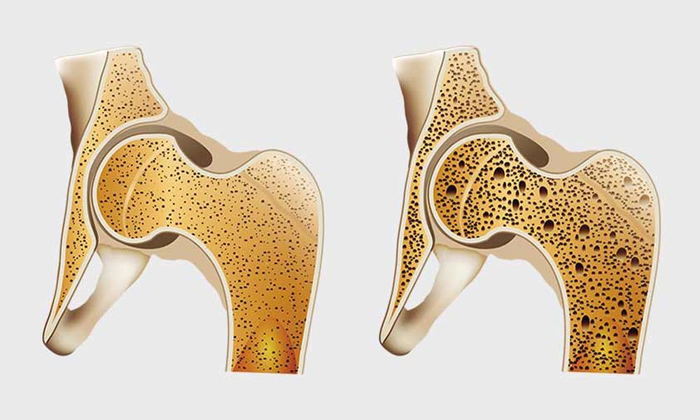 Osteoporosis Recovery Time