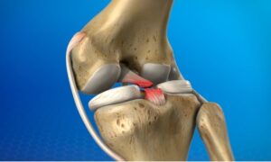 Menisküs Ameliyatı Neden Yapılır