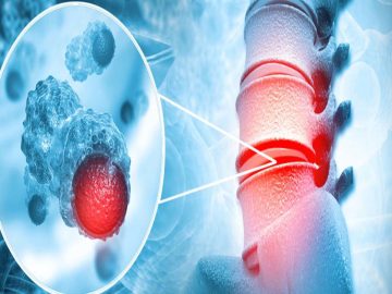 Yumuşak Doku Tümörü