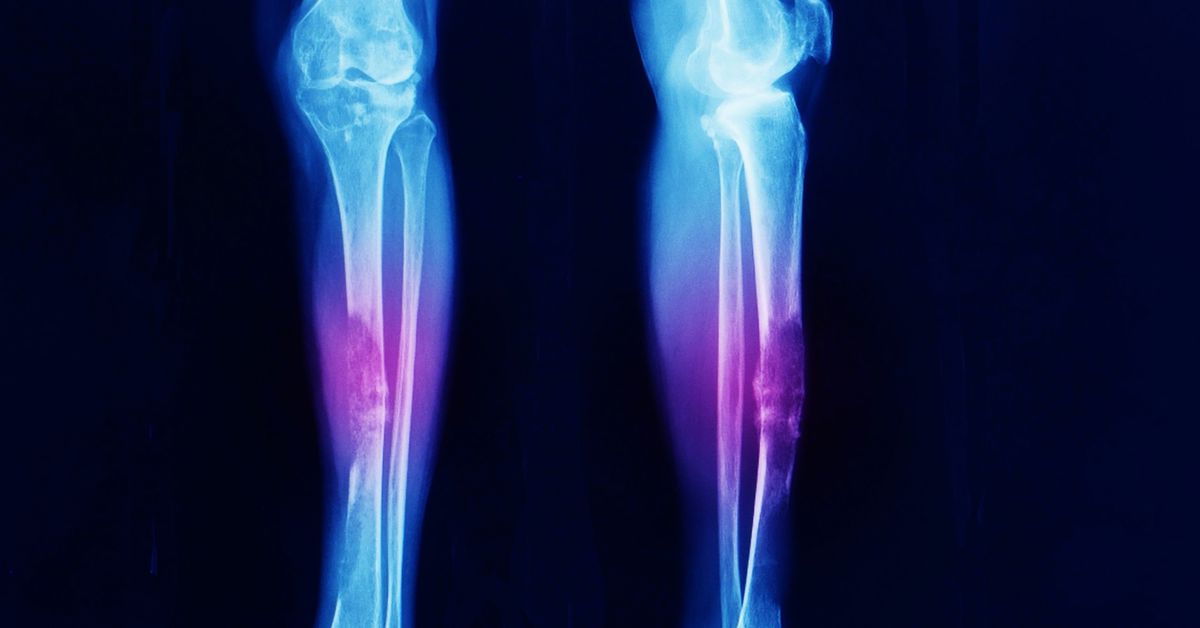 Yumuşak Doku Tümörü