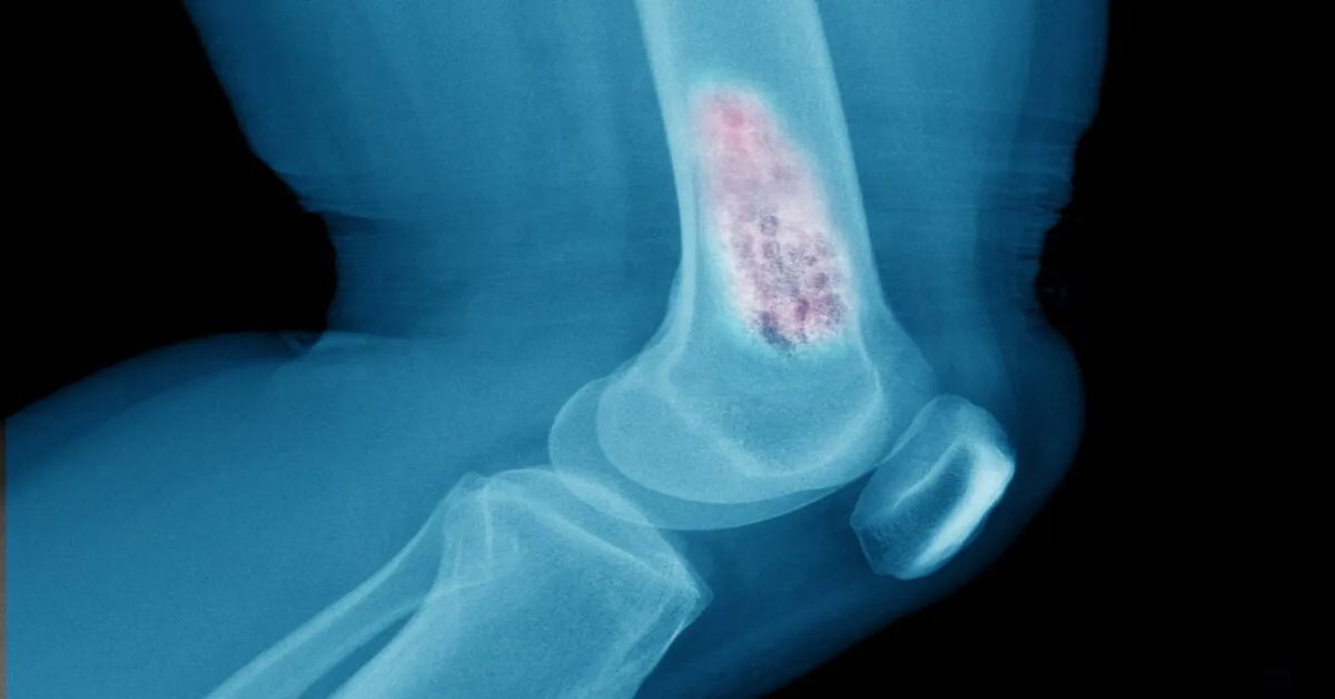 Yumuşak Doku Tümörü