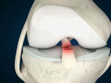 Ön Çapraz Bağ Yırtılması