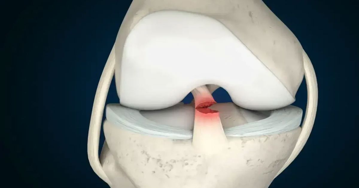 Ön Çapraz Bağ Yırtılması