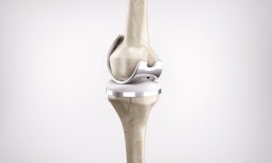 Robotic Knee Prosthesis Surgery