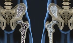 Osteoporosis Disease Symptoms