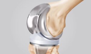 Robotik Diz Protezi Ameliyatı Sonrası