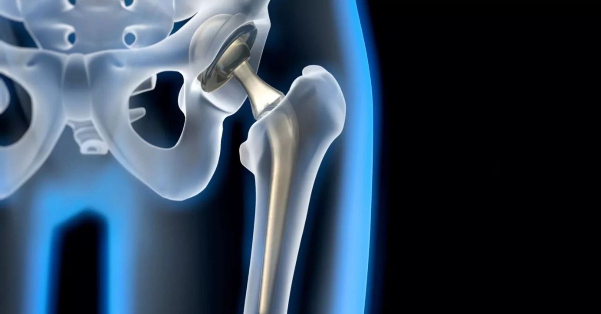 Robotik Kalça Protezi Ameliyatı Fiyatı Robotik Kalça Protezi Ameliyatı Fiyatı