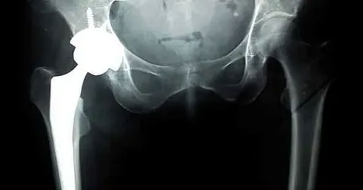 What is Hip Prosthesis?