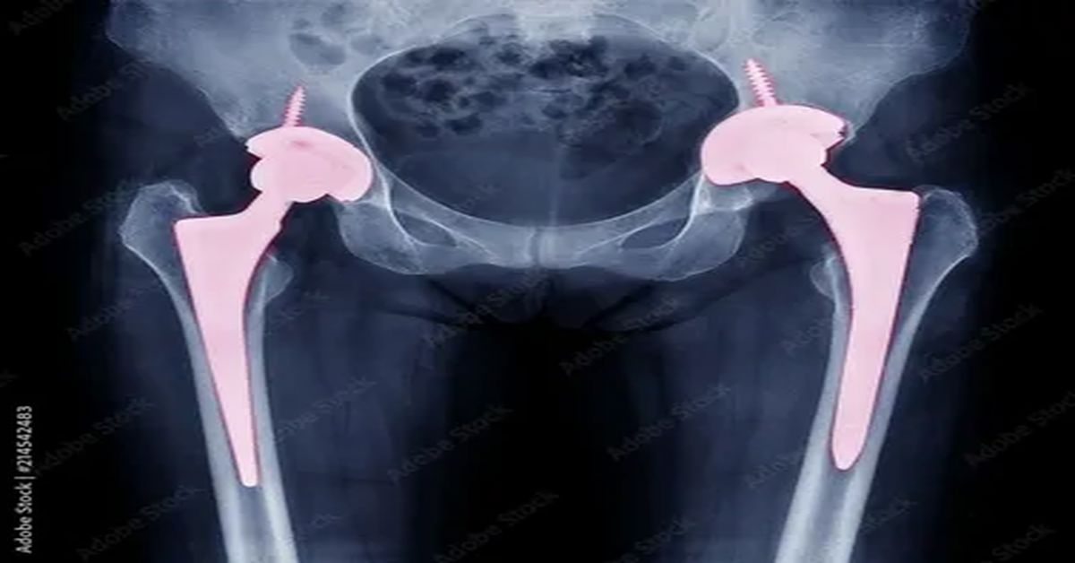 What is Hip Prosthesis?