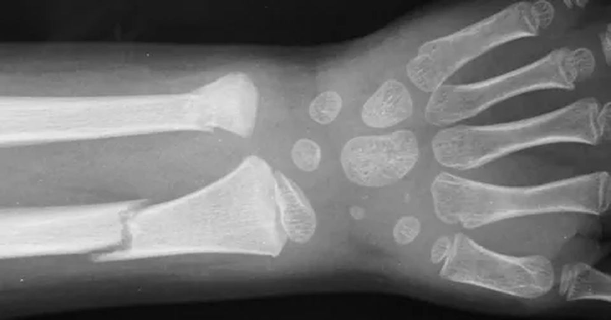 Cam Kemik Hastalığı Tedavisi