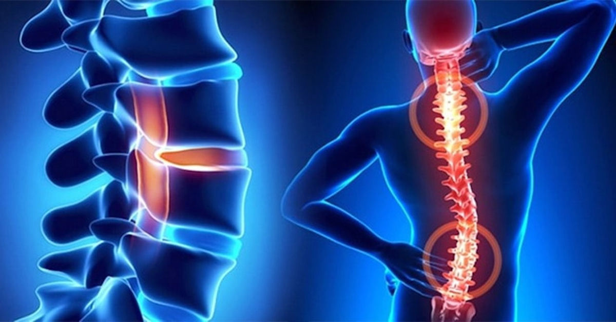 Omurga Fıtığı Tedavisi Omurga Fıtığı Tedavisi