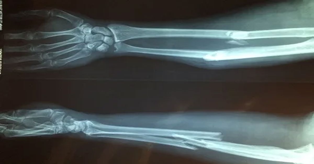 Cam Kemik Hastalığı Nedir? Cam Kemik Hastalığı Nedir?