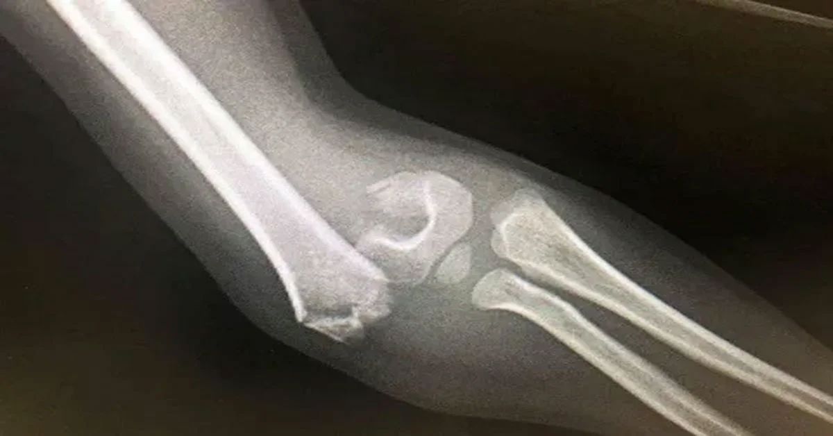 Cam Kemik Hastalığı Nedir? Cam Kemik Hastalığı Nedir?